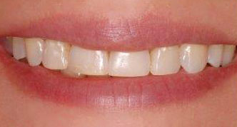 Woman smiling Before having teeth made-over