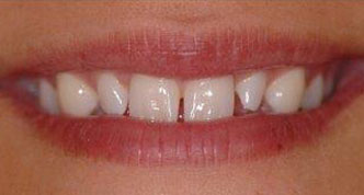 Woman smiling Before having teeth made-over